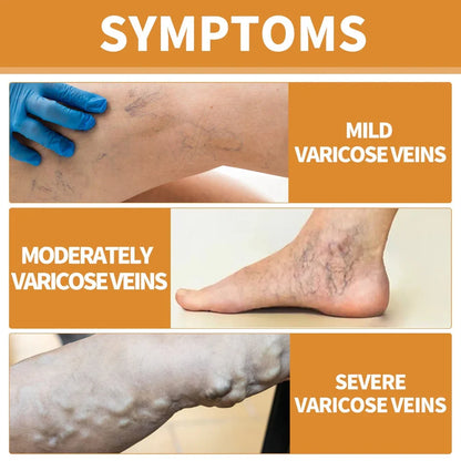 Turmeric Varicose Veins Relief Spray (BUY 1 GET 1 FREE💥 🎁 )