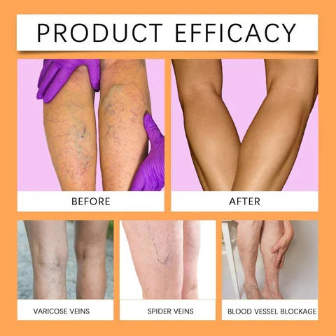 Turmeric Varicose Veins Relief Spray (BUY 1 GET 1 FREE💥 🎁 )